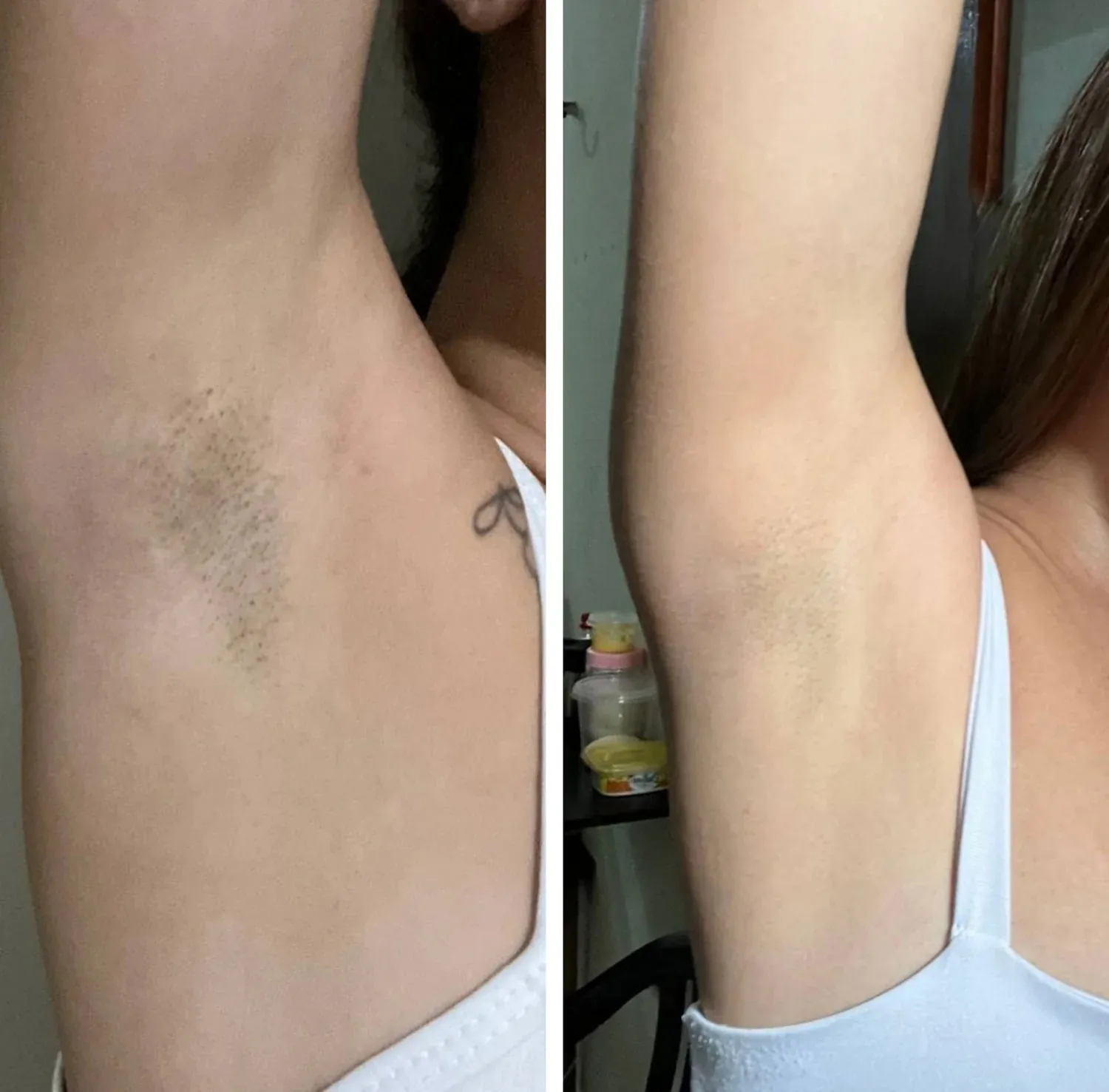 Antes e depois — clareamento das axilas